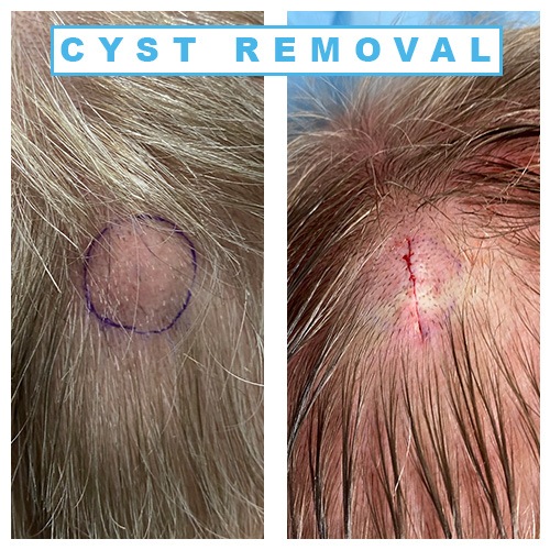 How Much Does Removal of a Cyst on the Back And Subcutaneous Tissue in an Office Cost